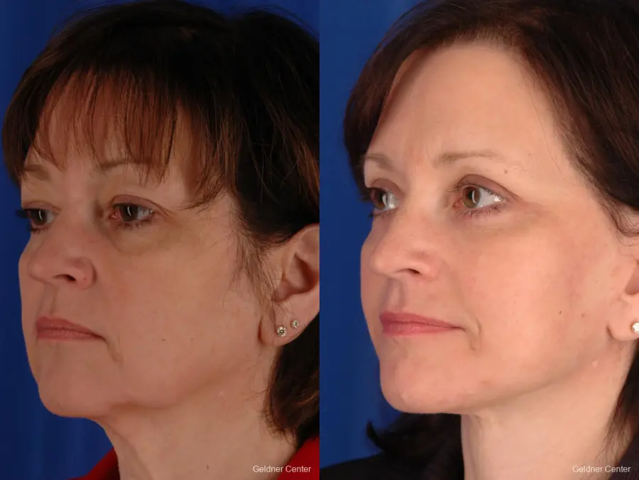 Facelift: Patient 1 - Before and After 5
