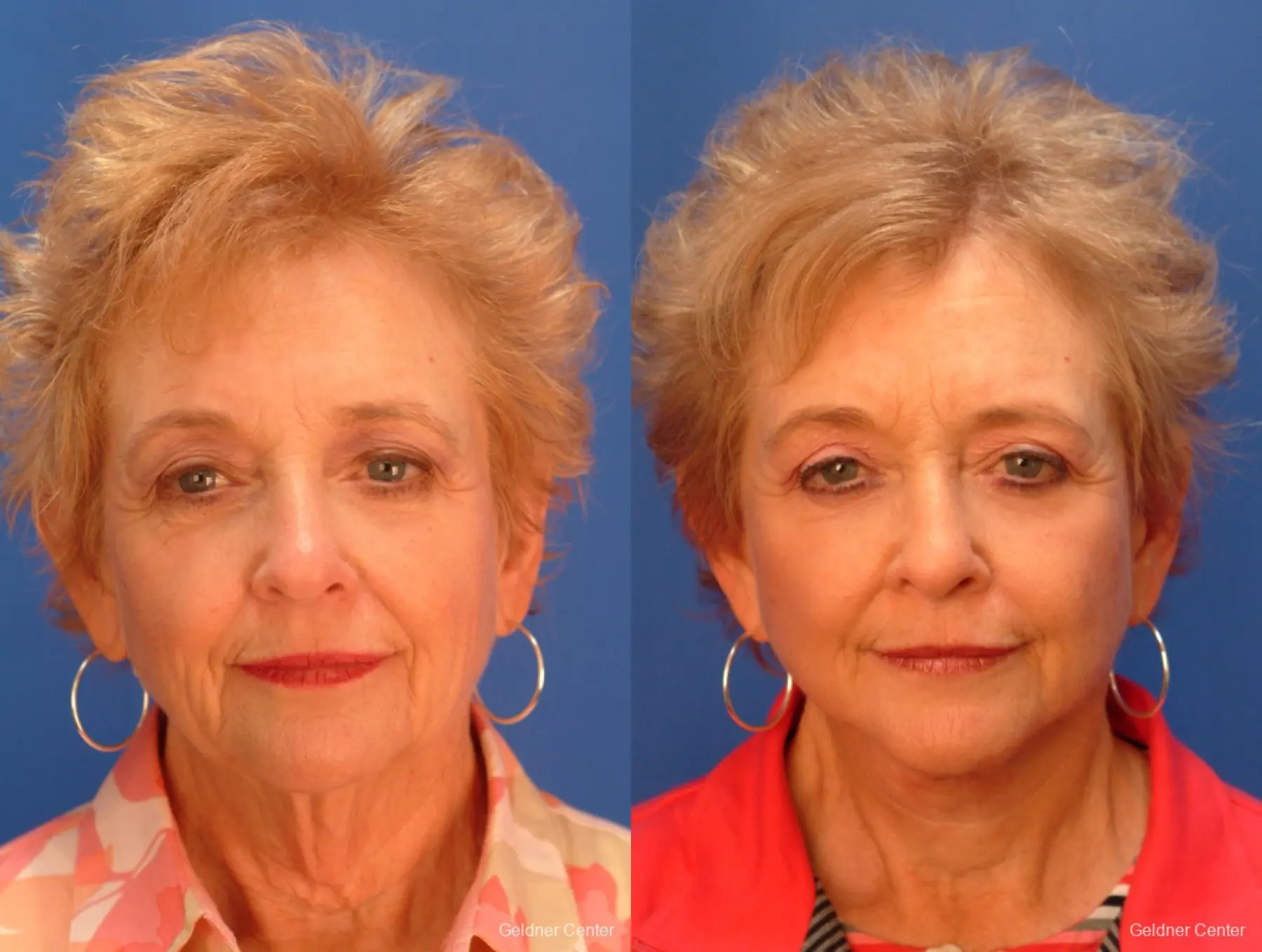 Facelift: Patient 7 - Before and After  