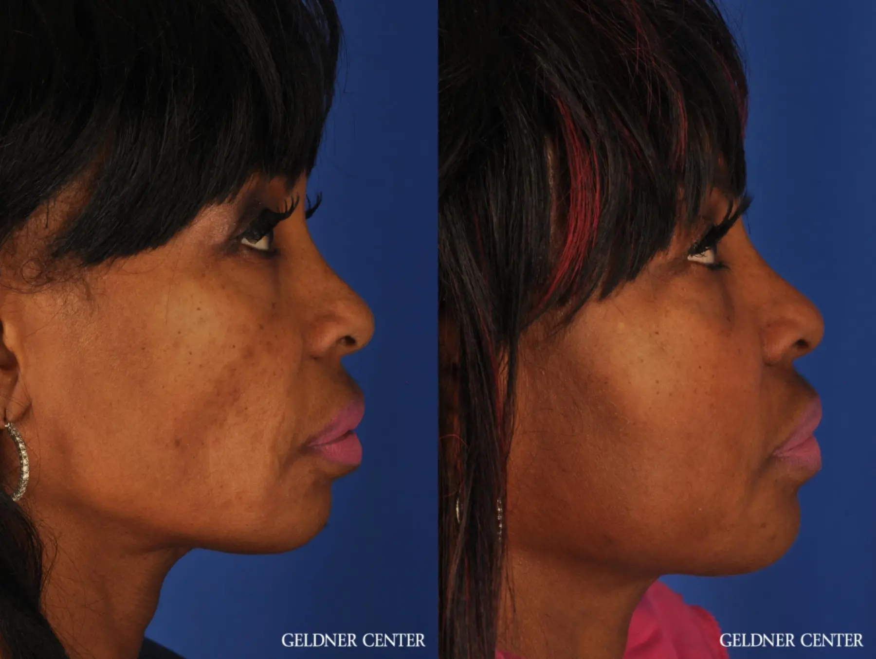 Fat Transfer to Face - Before and After 2