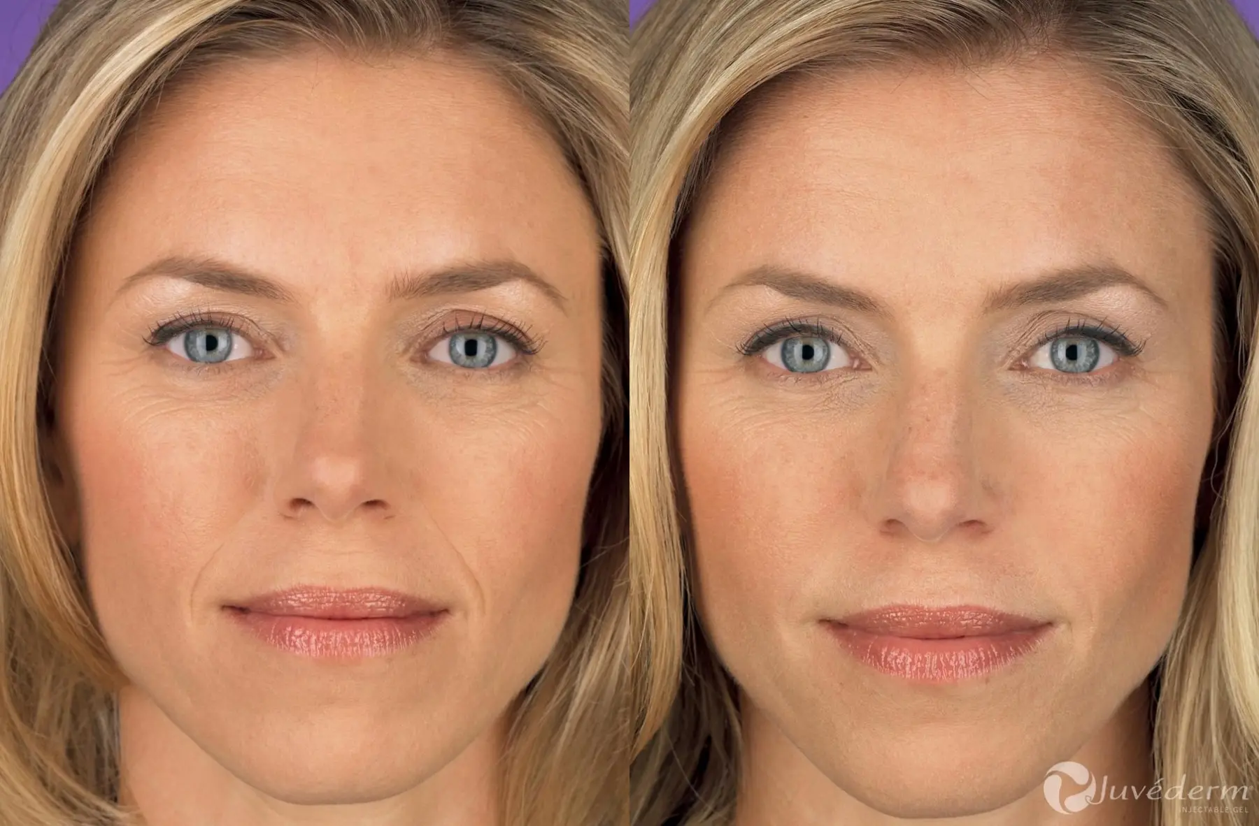 Juvéderm® - Before and After 1