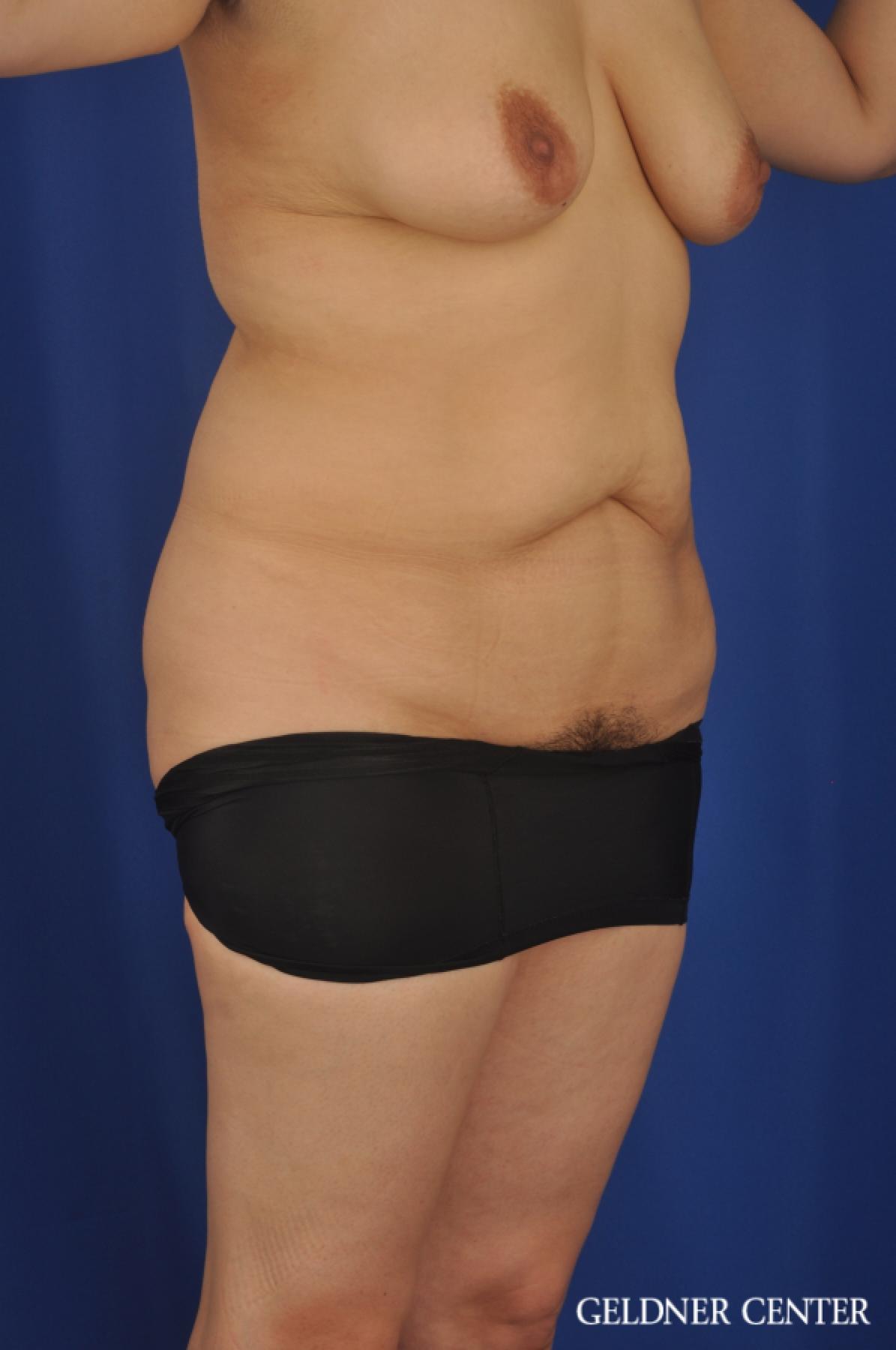Tummy Tuck: Patient 24 - Before 2