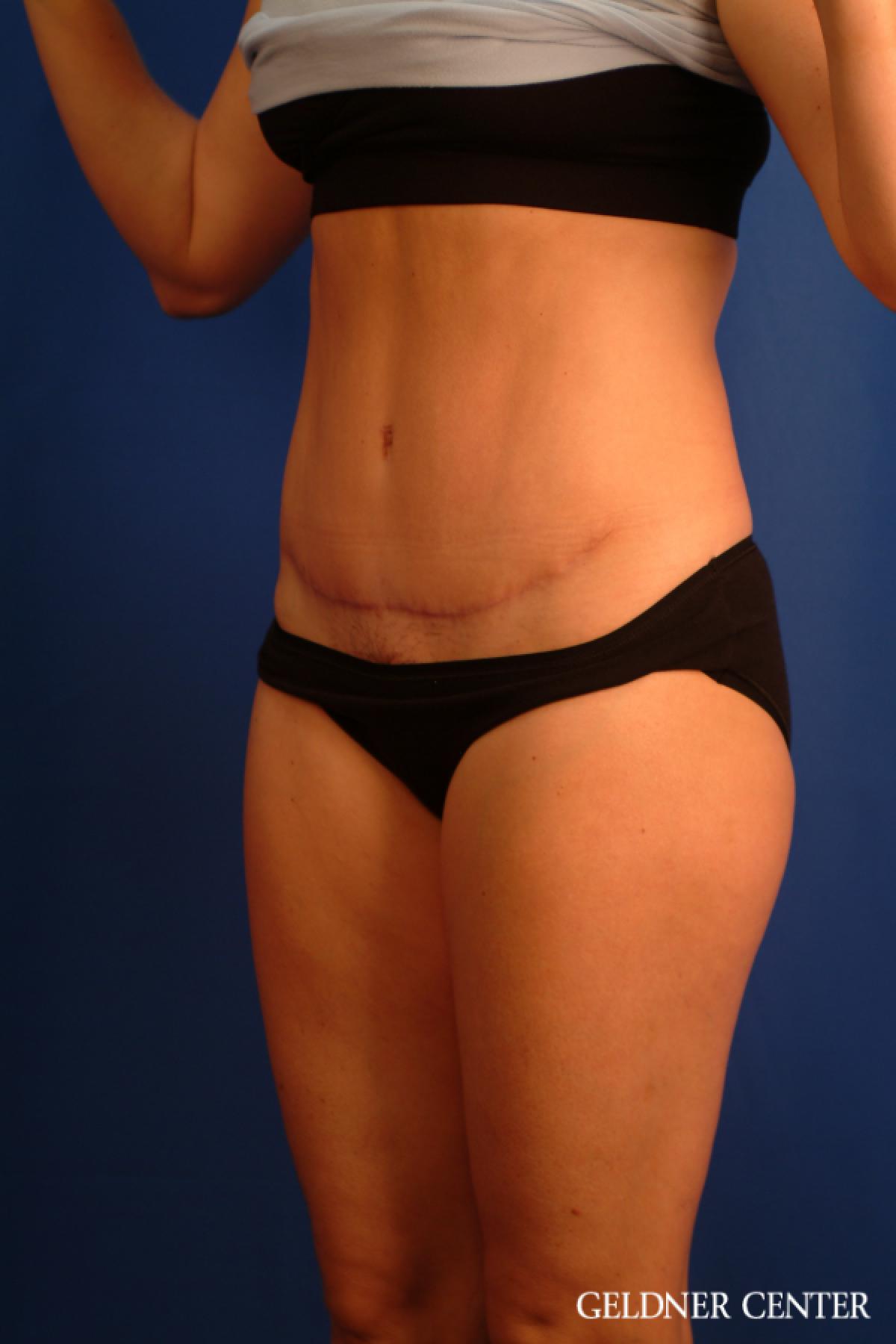 Tummy Tuck: Patient 34 - After 4