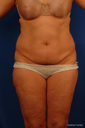 Lipoabdominoplasty: Patient 3 - Before Image 1