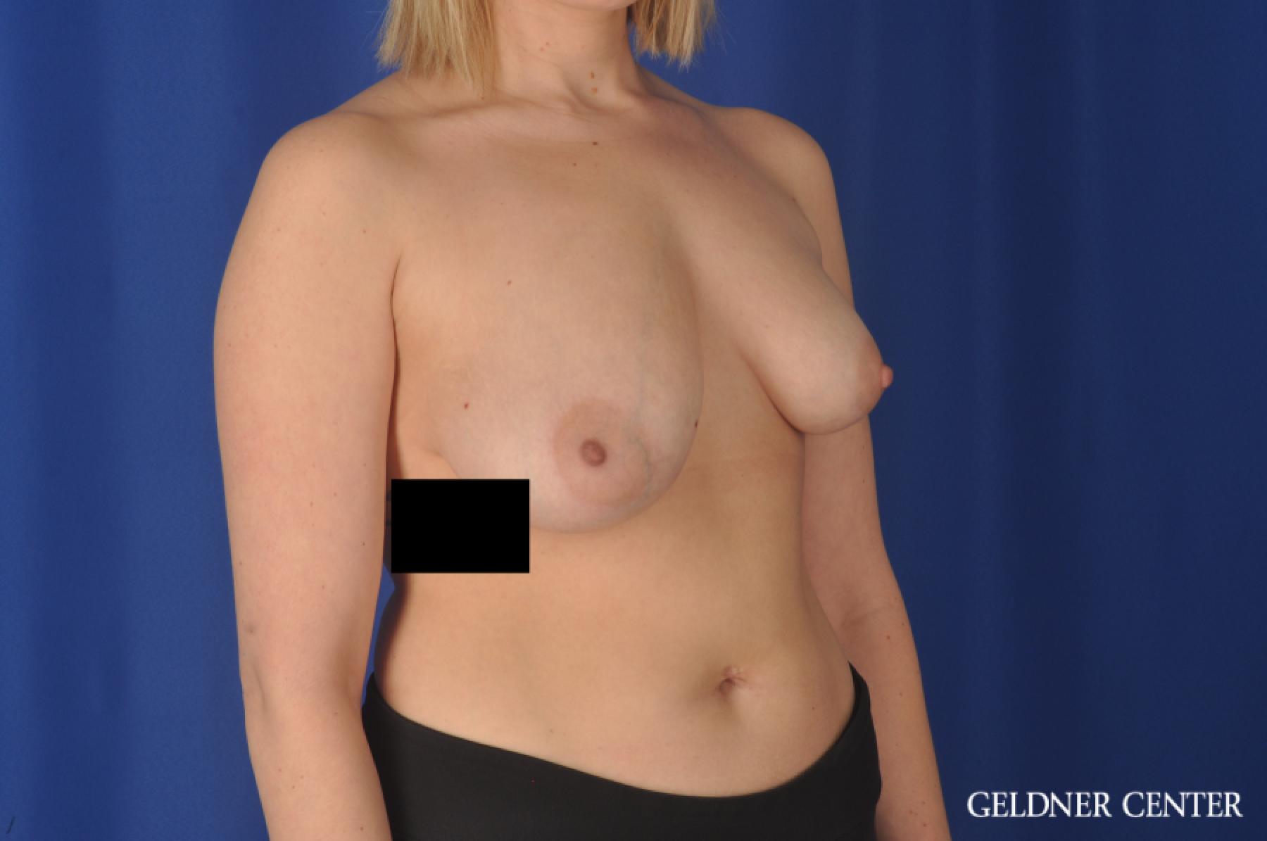 Breast Augmentation: Patient 148 - Before 2