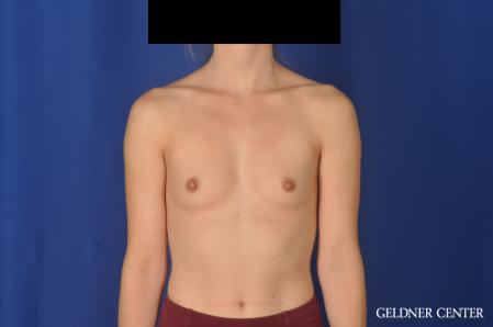 Breast Augmentation: Patient 187 - Before 1