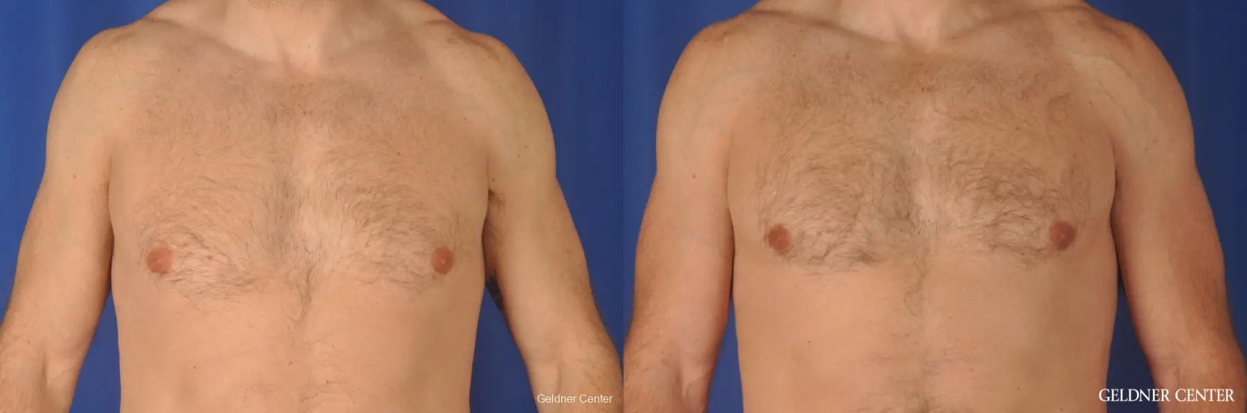 Gynecomastia: Patient 9 - Before and After  