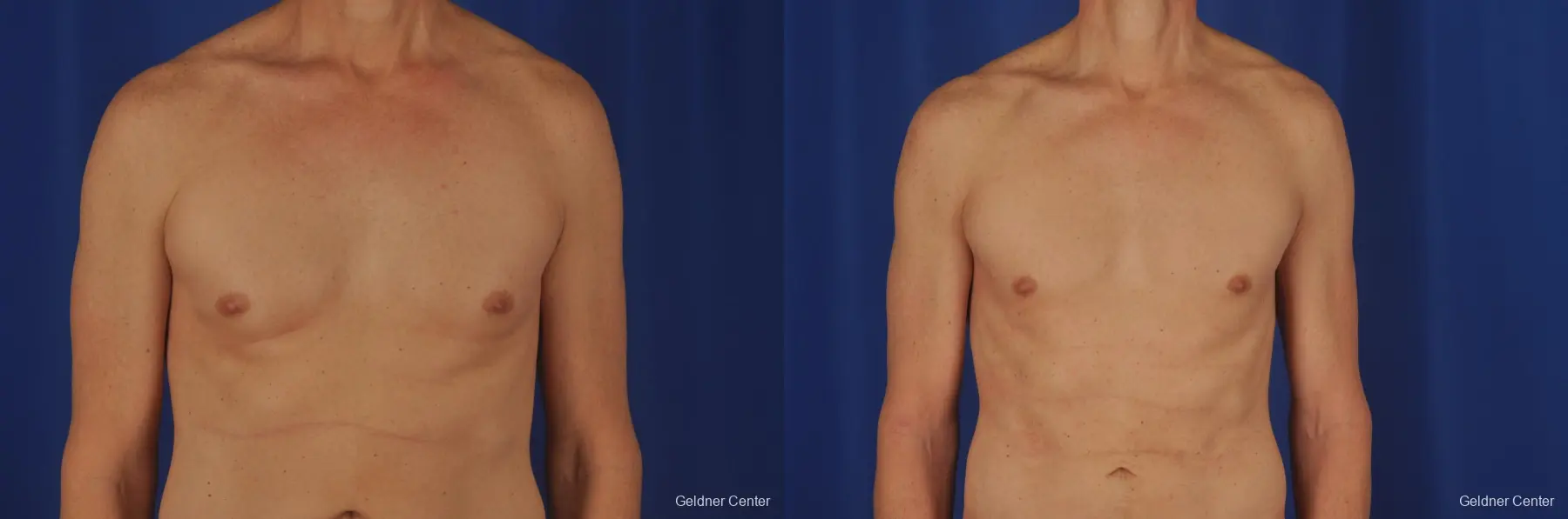 Gynecomastia: Patient 2 - Before and After  