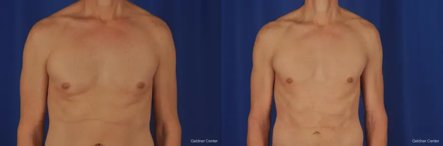 Gynecomastia: Patient 2 - Before and After  