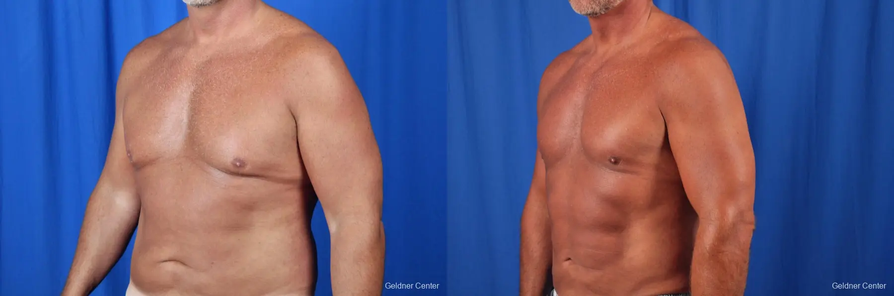 Gynecomastia: Patient 7 - Before and After 4