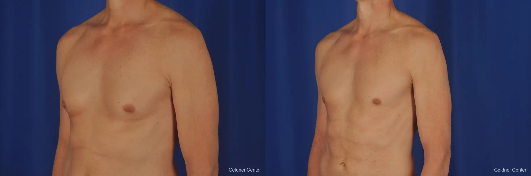 Gynecomastia: Patient 2 - Before and After 4