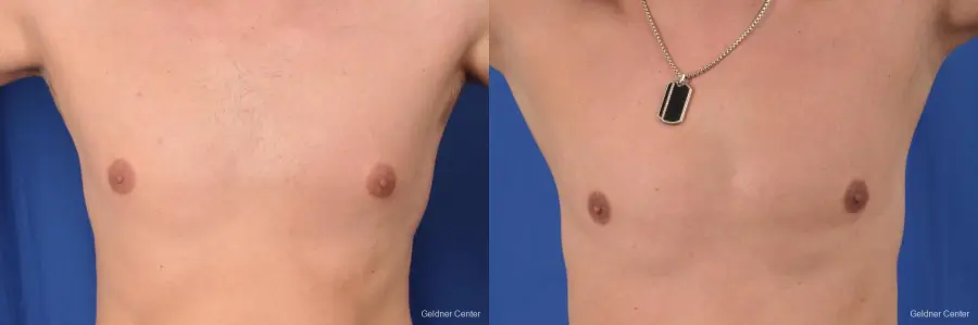 Gynecomastia: Patient 8 - Before and After 1