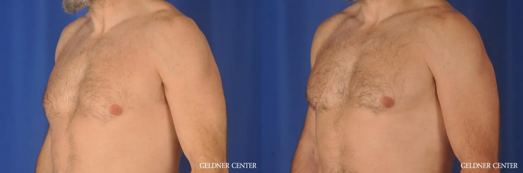 Gynecomastia: Patient 9 - Before and After 4