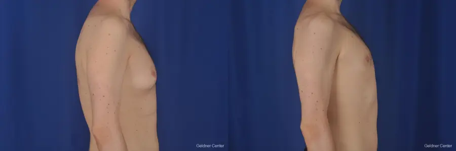 Gynecomastia: Patient 3 - Before and After 2