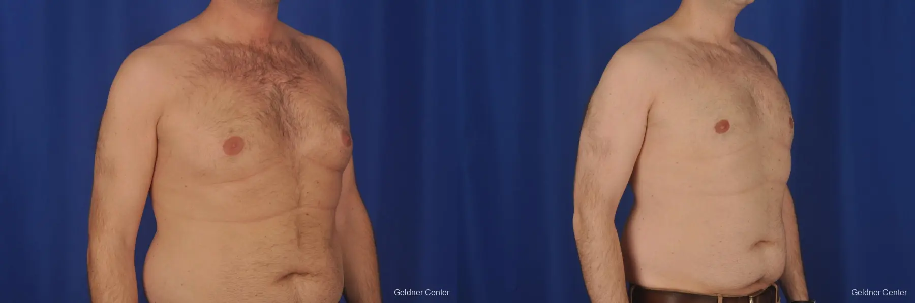 Gynecomastia: Patient 1 - Before and After 3