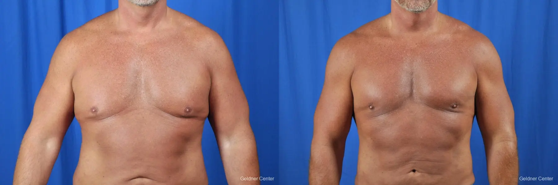 Gynecomastia: Patient 7 - Before and After  