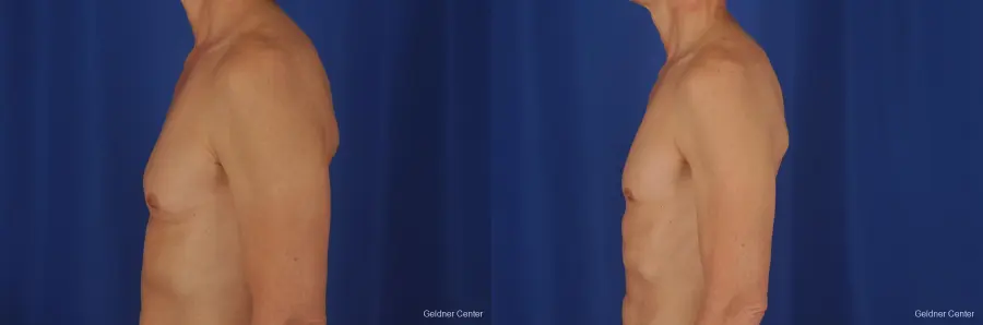 Gynecomastia: Patient 2 - Before and After 5