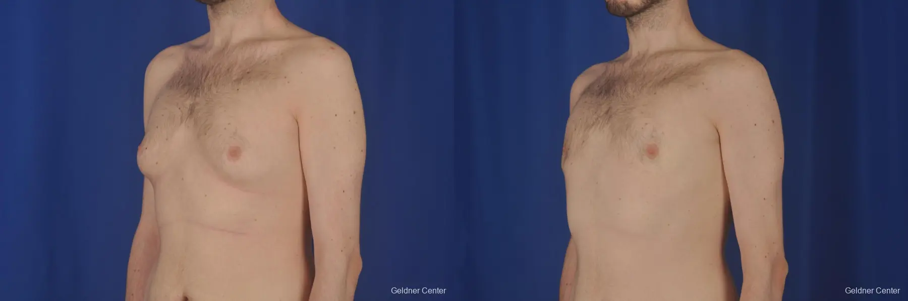 Gynecomastia: Patient 3 - Before and After 4