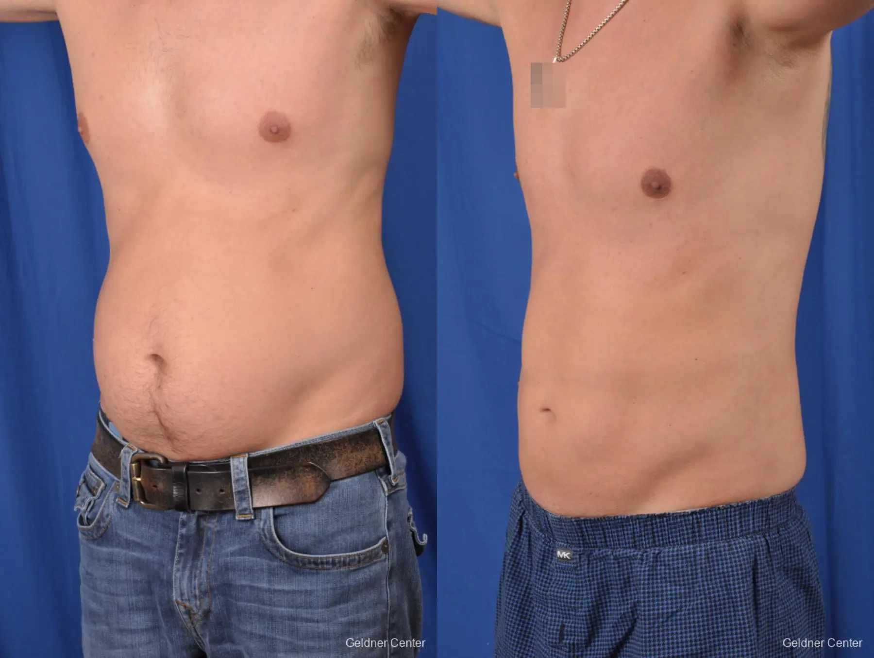 Gynecomastia: Patient 8 - Before and After 4