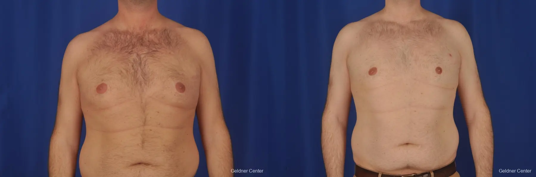 Gynecomastia: Patient 1 - Before and After  