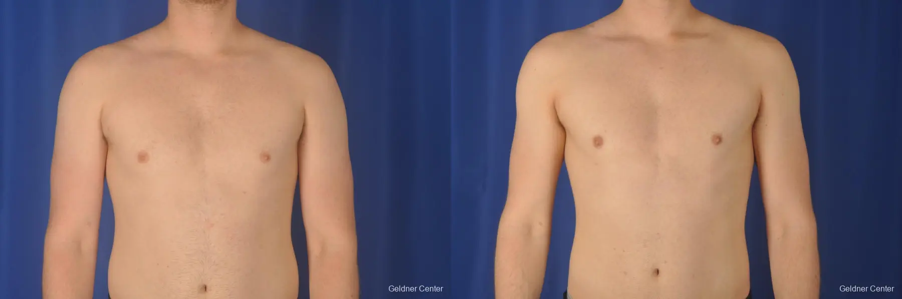 Gynecomastia: Patient 10 - Before and After 1