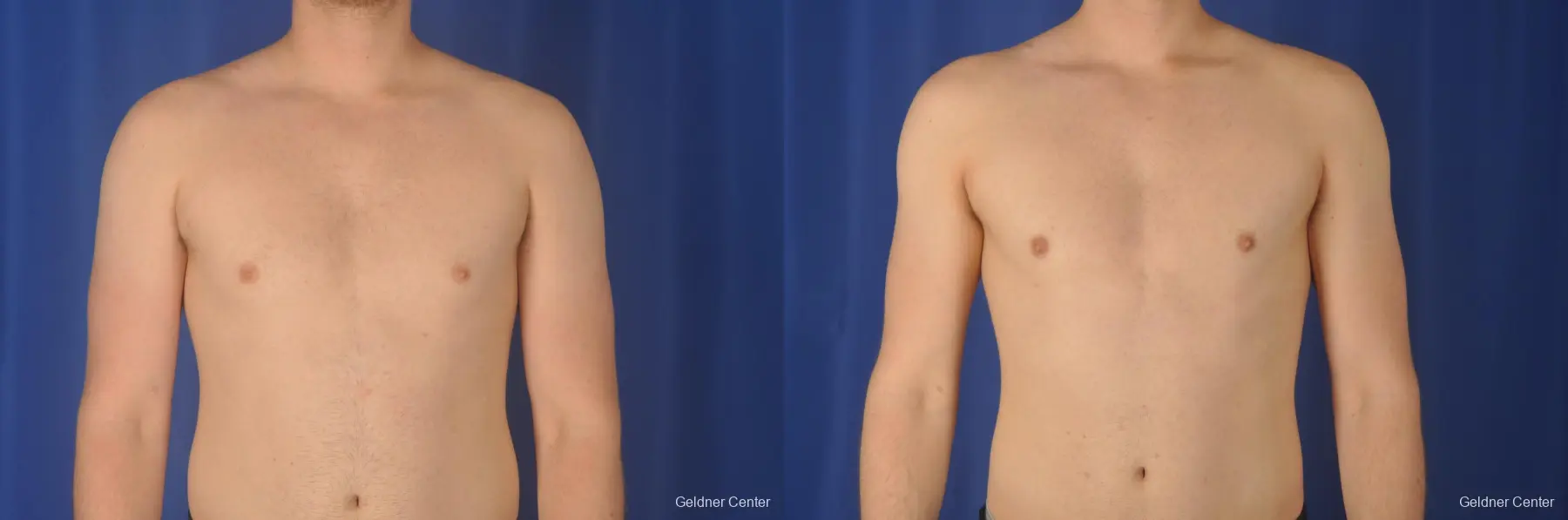 Gynecomastia: Patient 10 - Before and After  