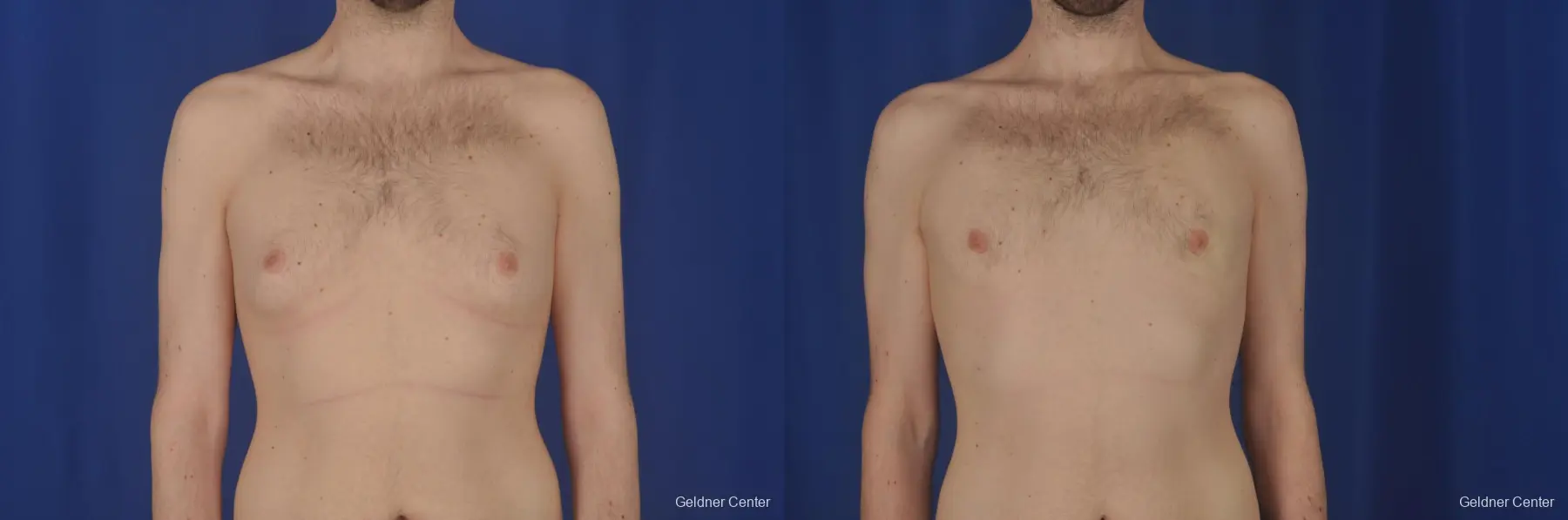 Gynecomastia: Patient 3 - Before and After  