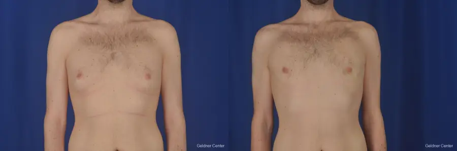Gynecomastia: Patient 3 - Before and After  