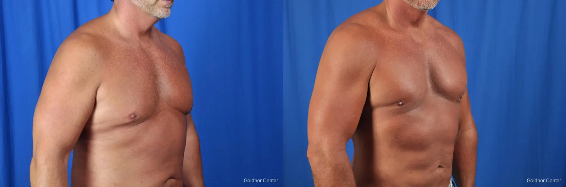 Gynecomastia: Patient 7 - Before and After 3