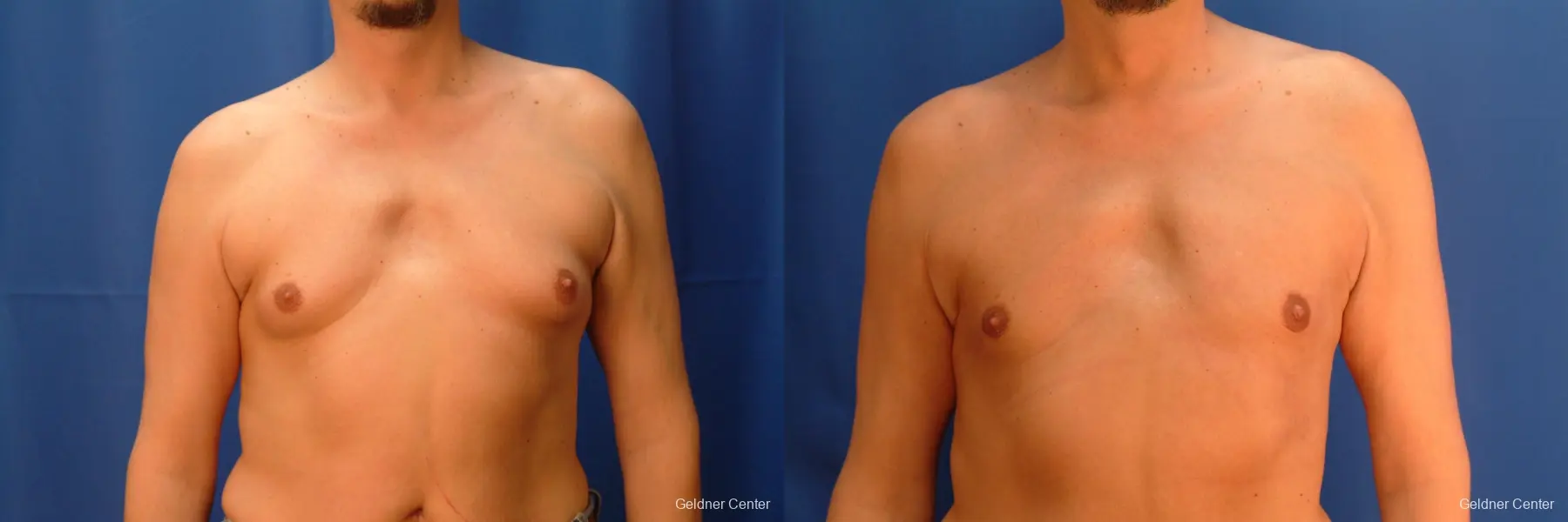 Gynecomastia: Patient 6 - Before and After  