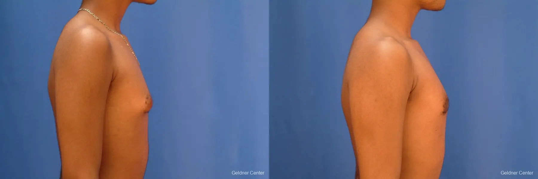 Gynecomastia: Patient 5 - Before and After 2