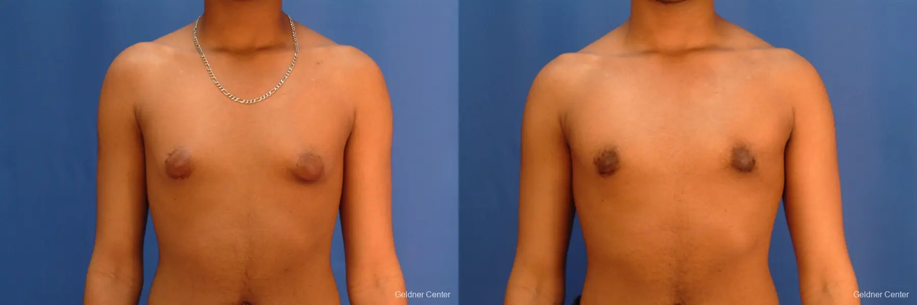 Gynecomastia: Patient 5 - Before and After  