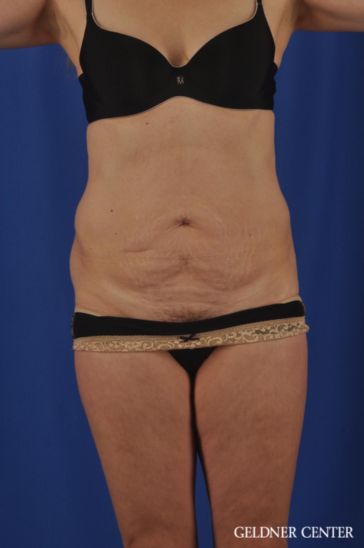 Chicago Abdominoplasty 11854 - Before