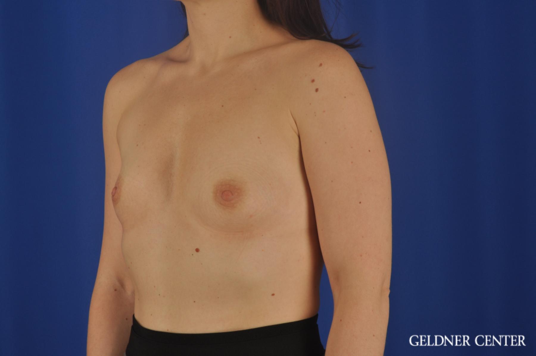 Chicago Breast Augmentation 8760 - Before and After 4