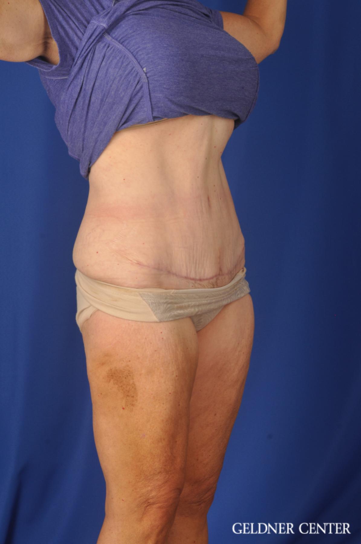 Abdominoplasty Lake Shore Dr, Chicago 11858 -  After 2