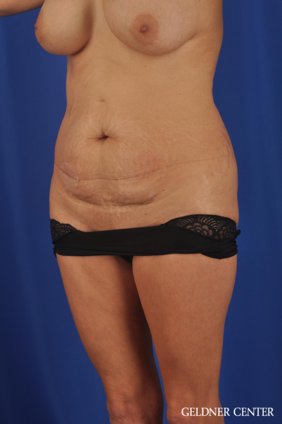 Abdominoplasty Streeterville, Chicago 11873 - Before and After 4