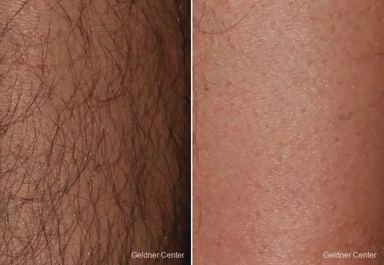 Hair reduction patient 2317 before and after photos - Before and After