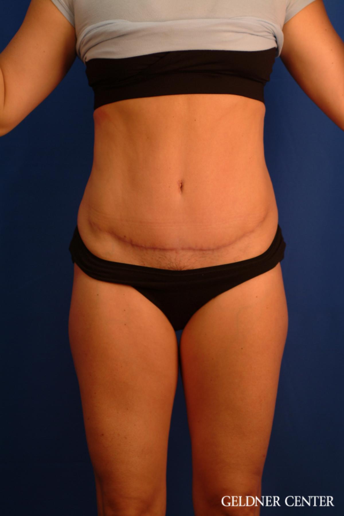 Tummy Tuck: Patient 34 - After 1
