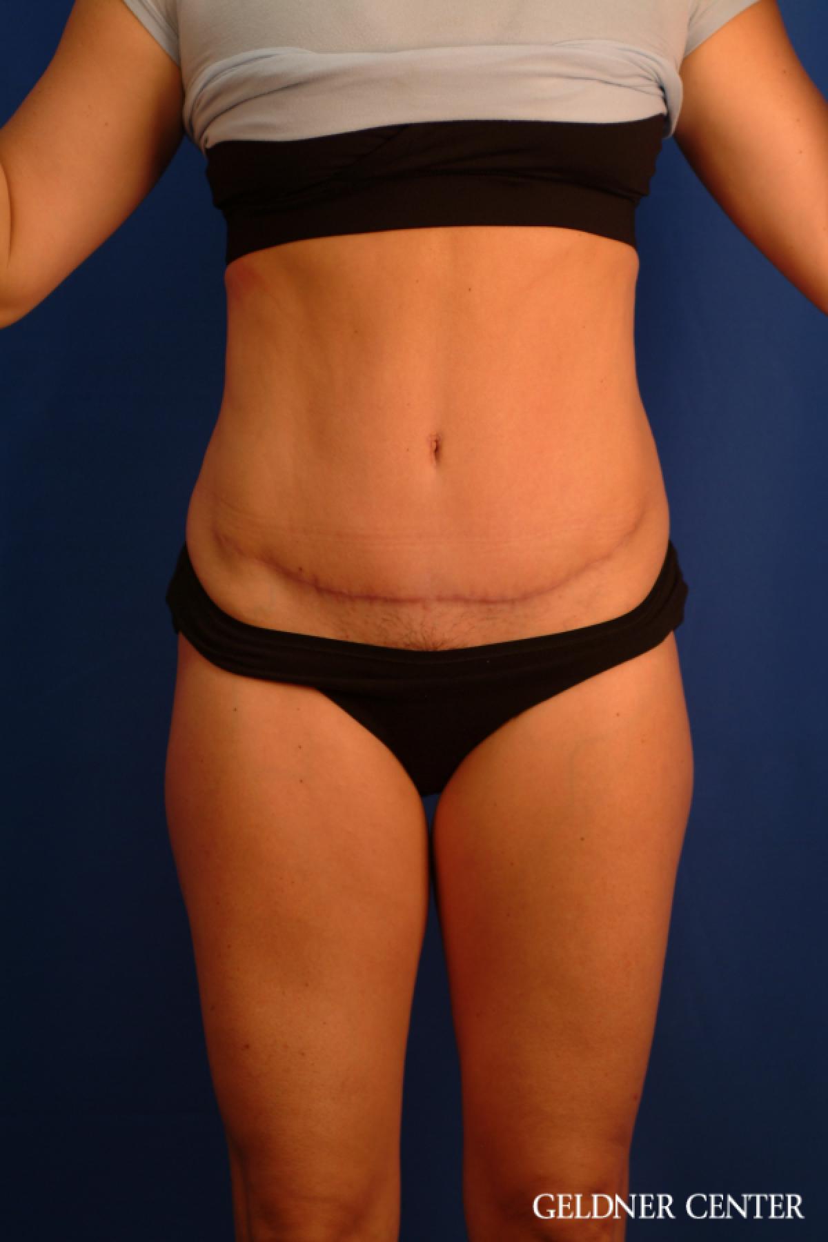 Tummy Tuck: Patient 34 - After 