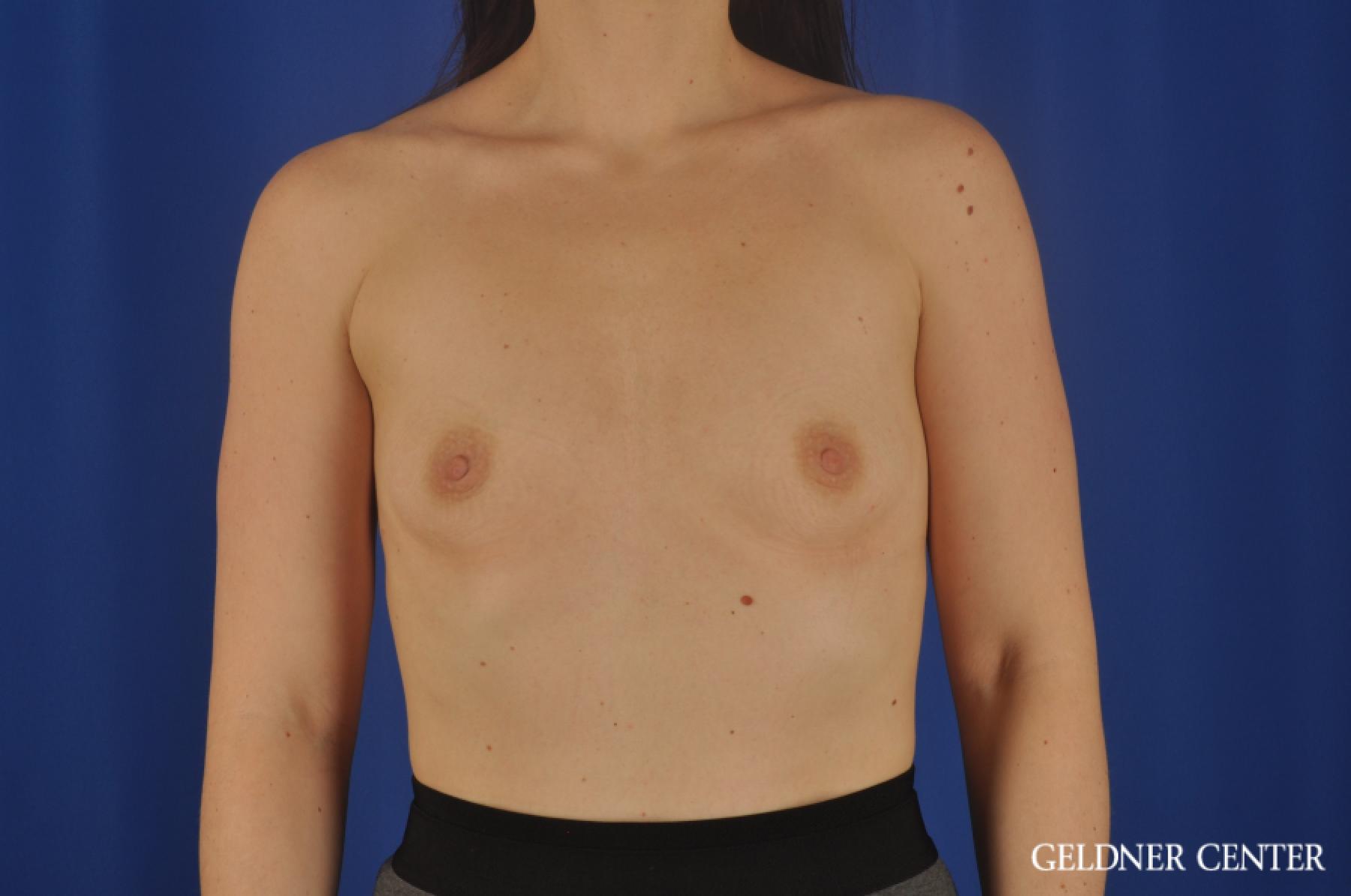 Chicago Breast Augmentation 8760 - Before 1
