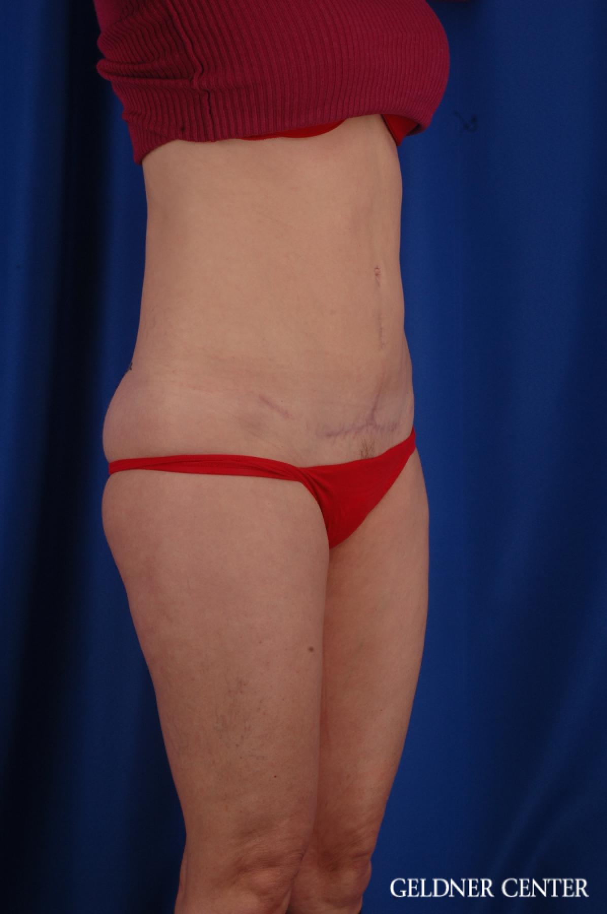 Tummy Tuck: Patient 36 - After 2