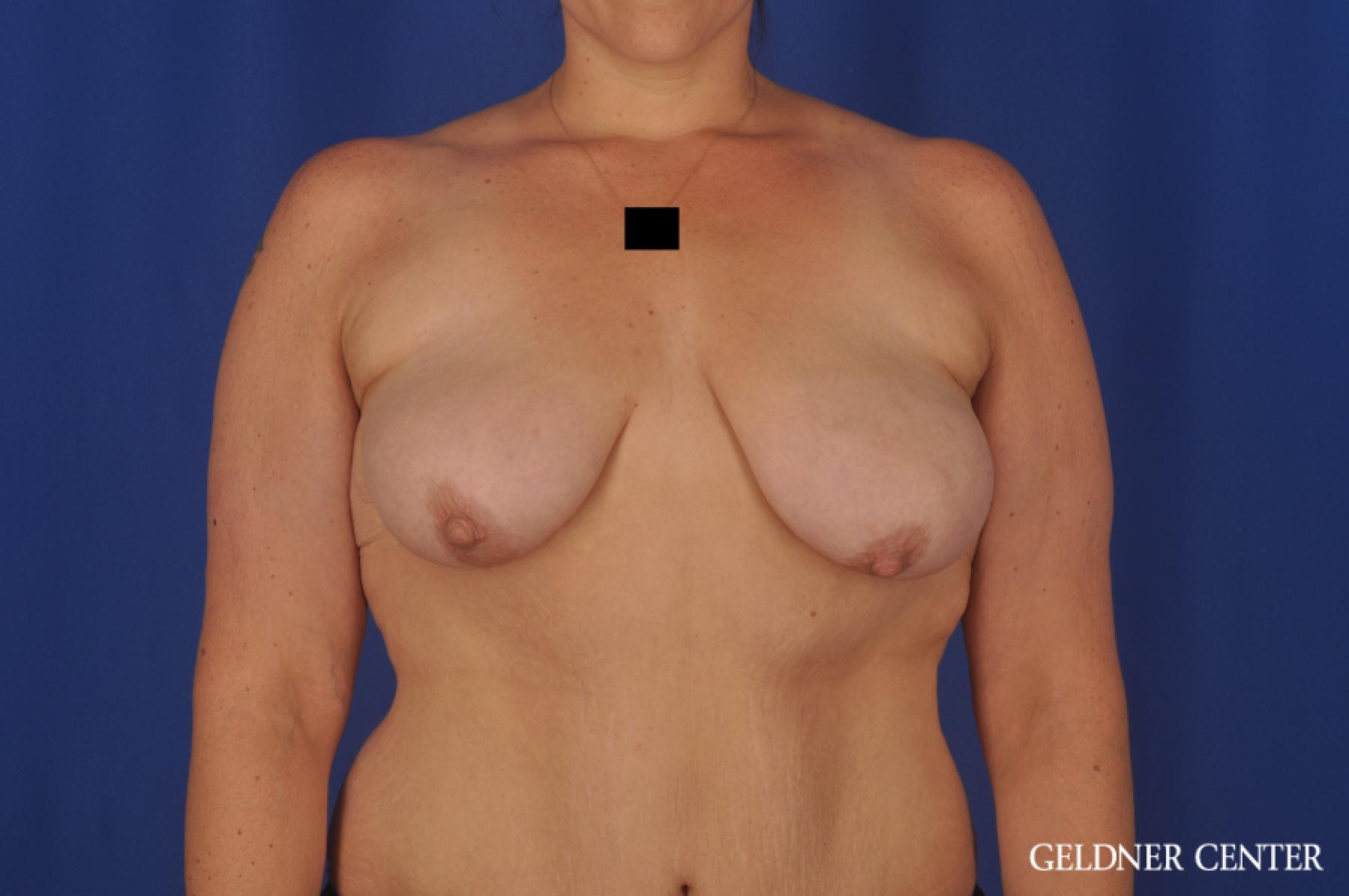 Breast Augmentation: Patient 162 - Before 1
