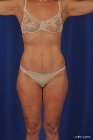 Lipoabdominoplasty: Patient 2 - After Image 1