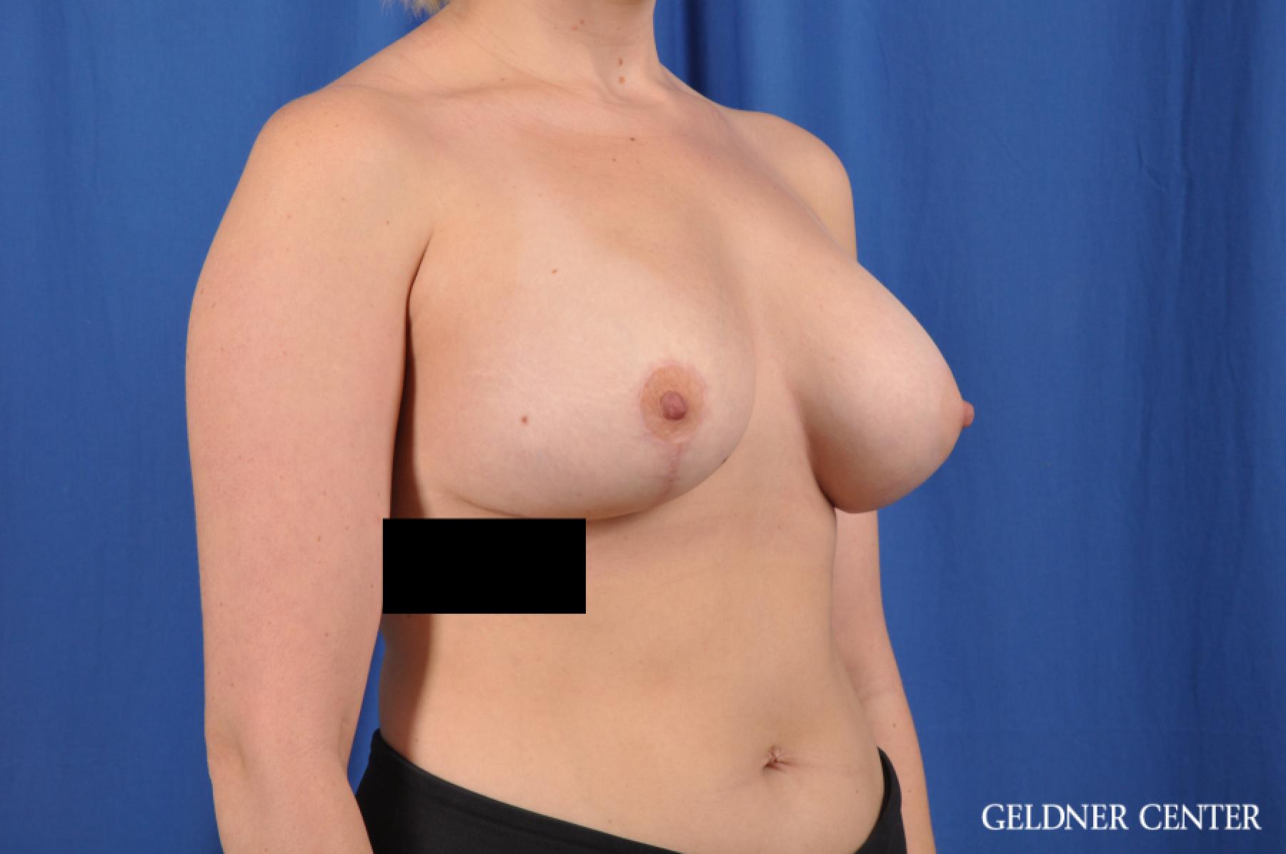 Breast Augmentation: Patient 148 - After 2