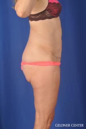 Chicago Abdominoplasty 11854 - After Image 3