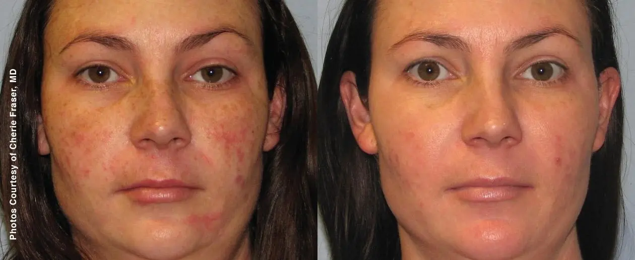 Laser: Patient 9 - Before and After 1