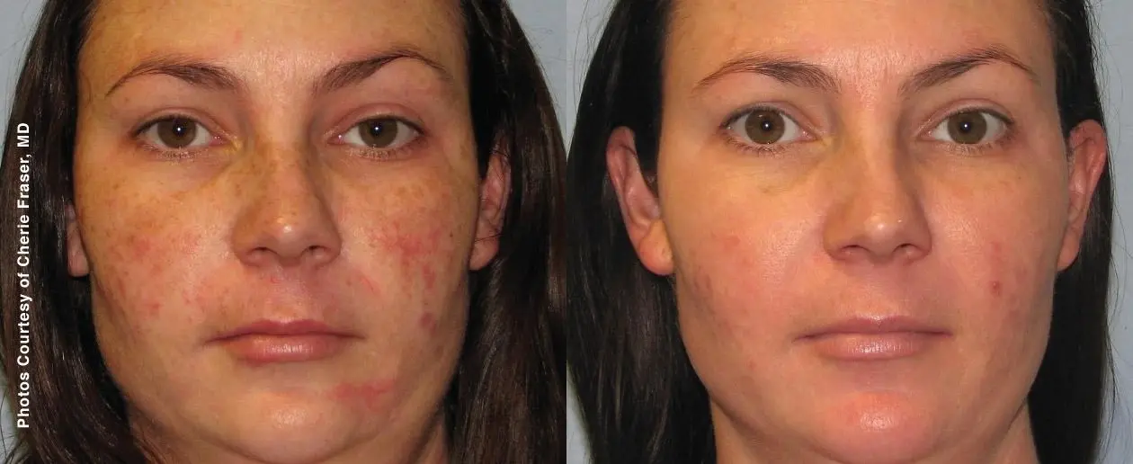 Laser: Patient 9 - Before and After  