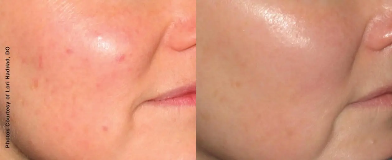 Laser: Patient 8 - Before and After  