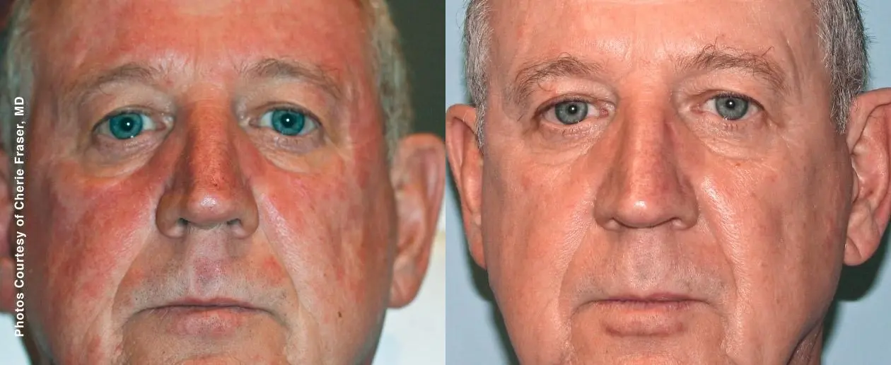 Laser For Men: Patient 2 - Before and After 1