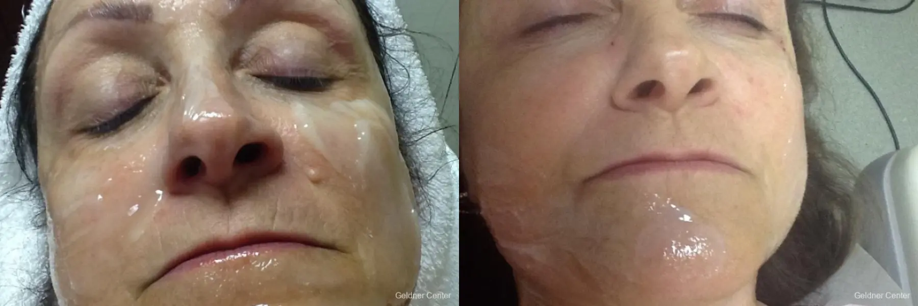 mole laser removal - Before and After  