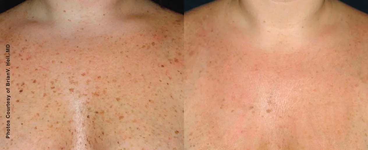 Before and after brown spot removal treatment in Oak Brook - Before and After 1